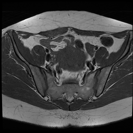 File:Adenomyosis-scar endometriosis (Radiopaedia 65863-75022 Axial T1 10).jpg