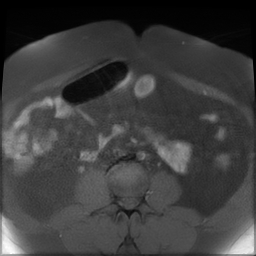 File:Adenomyosis within a didelphys uterus (Radiopaedia 70175-80215 Axial T1 fat sat 5).jpg