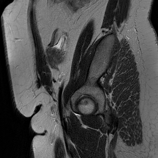 File:Adenomyosis within a didelphys uterus (Radiopaedia 70175-80215 Sagittal T2 35).jpg