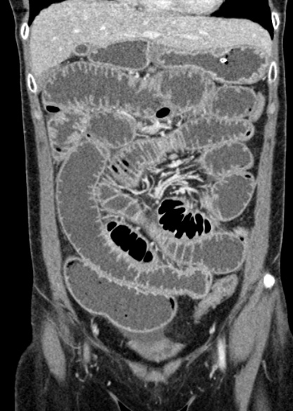 Adhesional small bowel obstruction (Radiopaedia 48397-53305 Coronal C+ portal venous phase 113).jpg