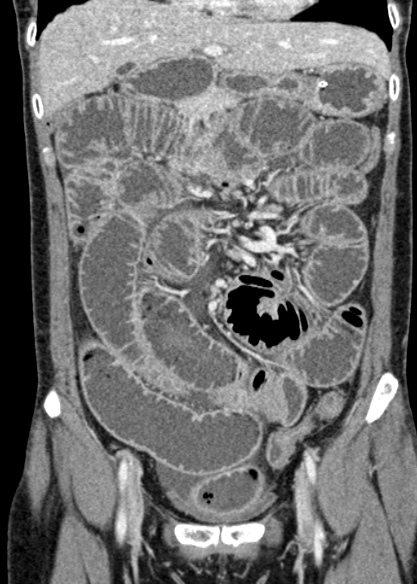 Adhesional small bowel obstruction (Radiopaedia 48397-53305 Coronal C+ portal venous phase 126).jpg