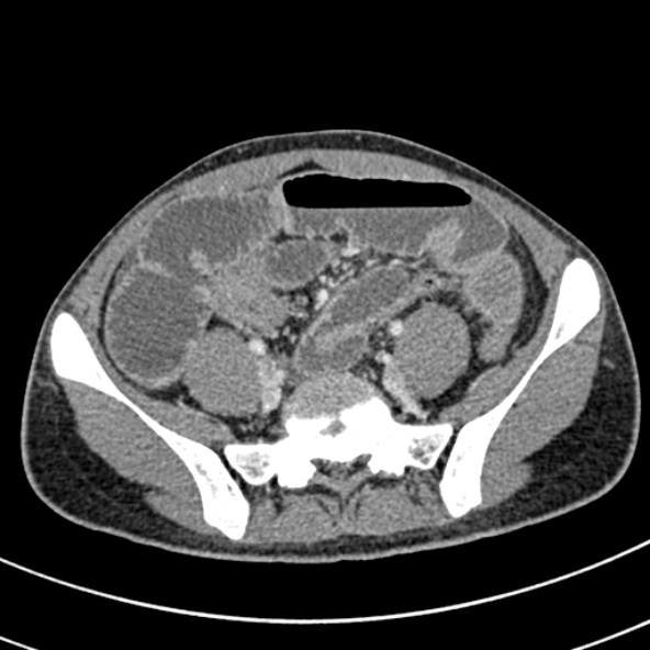 Adhesional small bowel obstruction (Radiopaedia 52107-57980 Axial C+ portal venous phase 91).jpg