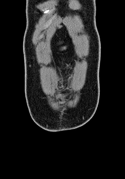 Adhesional small bowel obstruction (Radiopaedia 58900-66131 Coronal C+ portal venous phase 59).jpg