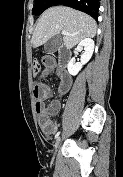 Adhesional small bowel obstruction (Radiopaedia 58900-66131 Sagittal C+ portal venous phase 83).jpg