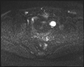 Adnexal multilocular cyst (O-RADS US 3- O-RADS MRI 3) (Radiopaedia 87426-103754 Axial DWI 46).jpg