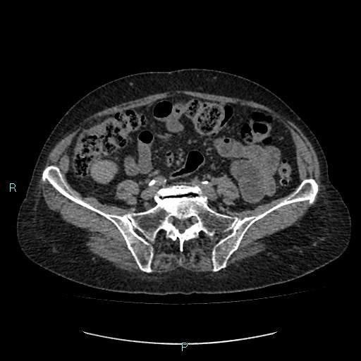 File:Adrenal collision tumor (ACT) (Radiopaedia 48462-53379 Axial non-contrast 42).jpg