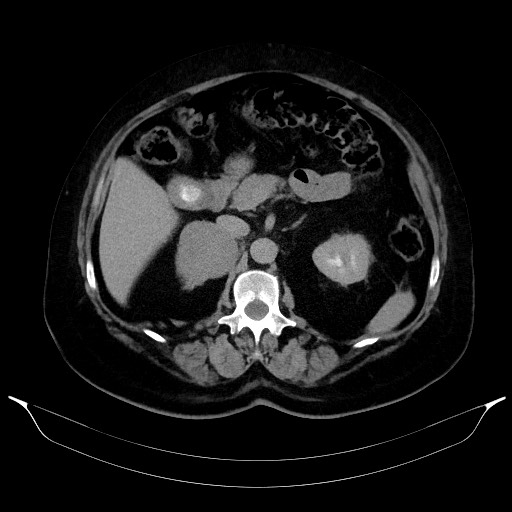 Adrenal cortical carcinoma (Radiopaedia 64017-72769 Axial C+ delayed 27).jpg