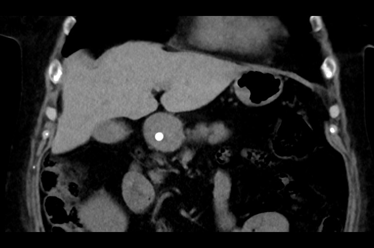 Adrenal cortical carcinoma (Radiopaedia 64017-72769 Coronal non-contrast 19).jpg