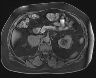 Adrenal cortical carcinoma (Radiopaedia 64017-72770 Axial T1 fat sat 35).jpg