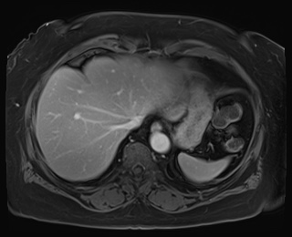 Adrenal cortical carcinoma (Radiopaedia 64017-72770 J 9).jpg