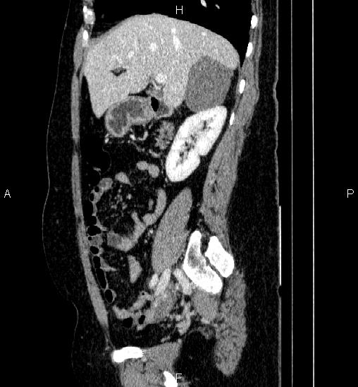 Adrenal cortical carcinoma (Radiopaedia 84882-100379 Sagittal C+ portal venous phase 31).jpg
