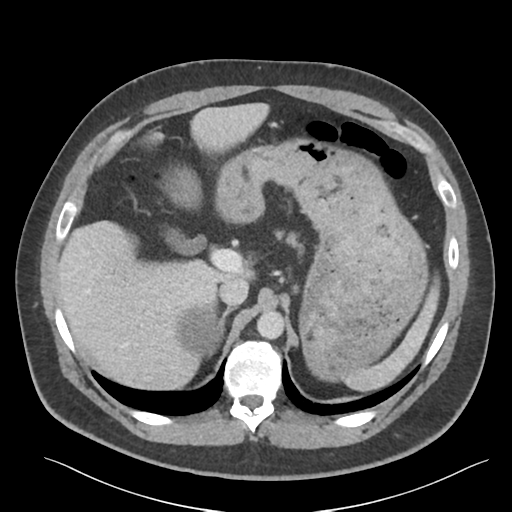 File:Adrenal cyst (Radiopaedia 45625-49777 Axial C+ portal venous phase 30).png