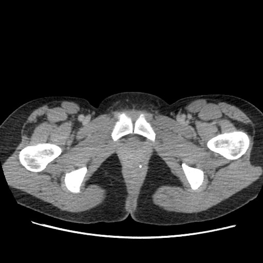 Adrenal cyst (Radiopaedia 64869-73813 Axial C+ portal venous phase 83).jpg