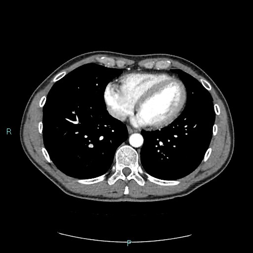 Adrenal cystic lymphangioma (Radiopaedia 83161-97534 Axial C+ arterial phase 3).jpg