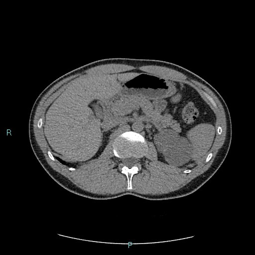 Adrenal cystic lymphangioma (Radiopaedia 83161-97534 Axial non-contrast 32).jpg