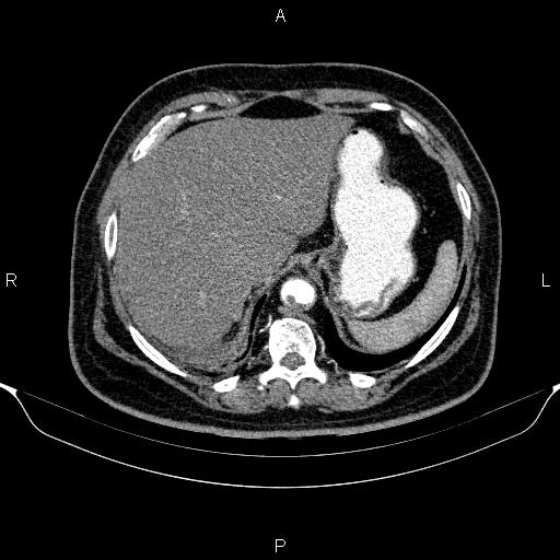 Adrenal hemorrhage (Radiopaedia 62622-70916 Axial C+ arterial phase 58).jpg