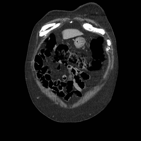 Adrenal lymphoma (Radiopaedia 84145-99415 Coronal C+ portal venous phase 5).jpg
