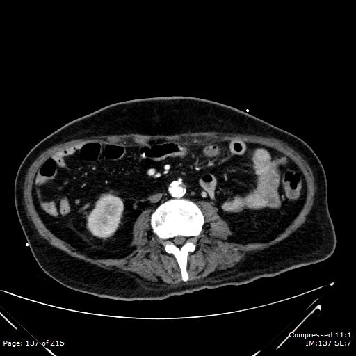 Adrenal metastasis (Radiopaedia 78425-91079 Axial C+ arterial phase 67).jpg