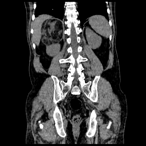 File:Adrenal myelolipoma (Radiopaedia 41843-44834 Coronal non-contrast 17).jpg