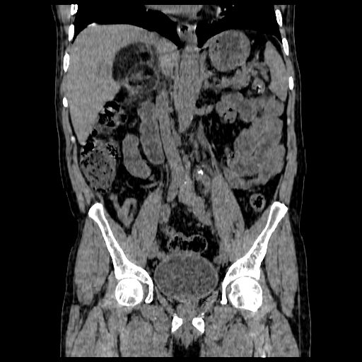File:Adrenal myelolipoma (Radiopaedia 41843-44834 Coronal non-contrast 4).jpg