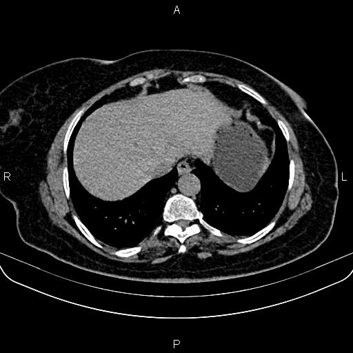 Adrenal myelolipoma (Radiopaedia 82742-96986 Axial non-contrast 11).jpg