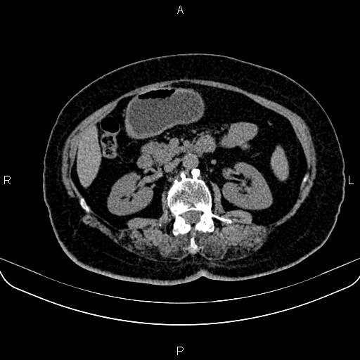 File:Adrenal myelolipoma (Radiopaedia 82742-96986 Axial non-contrast 68).jpg
