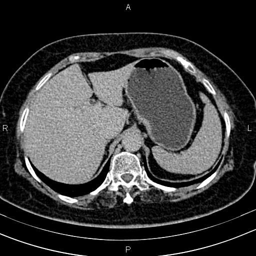 Adrenal myelolipoma (Radiopaedia 82742-96986 Axial renal excretory phase 26).jpg