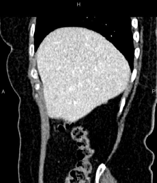 Adrenal myelolipoma (Radiopaedia 82742-96986 Sagittal renal cortical phase 26).jpg
