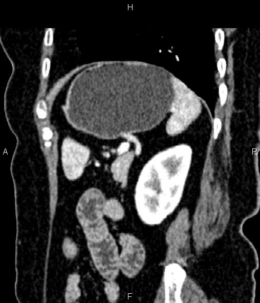 Adrenal myelolipoma (Radiopaedia 82742-96986 Sagittal renal cortical phase 82).jpg