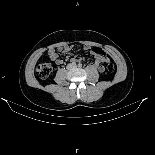Adrenal myelolipoma (Radiopaedia 87794-104246 Axial renal excretory phase 59).jpg