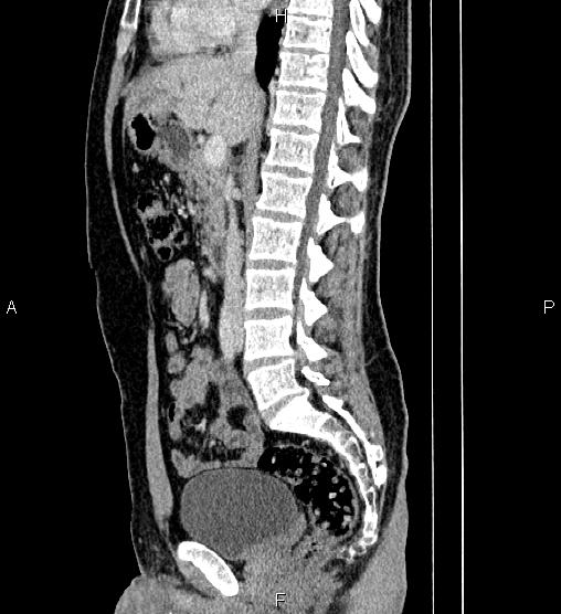 Adrenal myelolipoma (Radiopaedia 87794-104246 Sagittal renal cortical phase 45).jpg