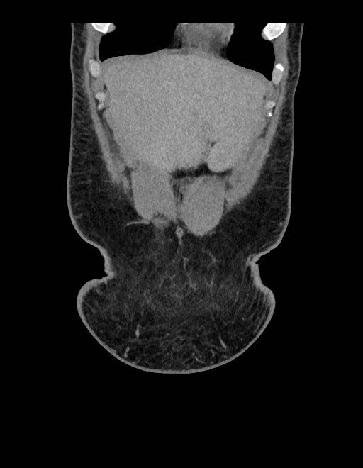 Adrenal myelolipoma - bilateral (Radiopaedia 74805-85810 Coronal C+ portal venous phase 234).jpg