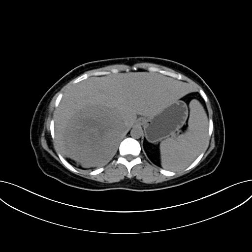 Adrenocortical carcinoma (Radiopaedia 87281-103569 Axial non-contrast 20).jpg