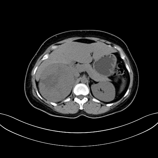 Adrenocortical carcinoma (Radiopaedia 87281-103569 Axial non-contrast 31).jpg