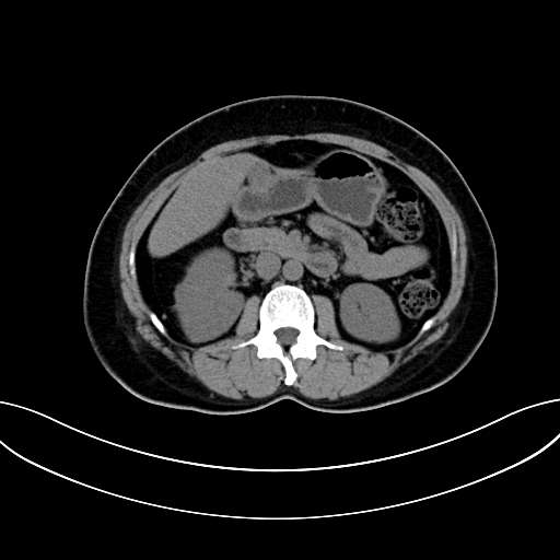 Adrenocortical carcinoma (Radiopaedia 87281-103569 Axial non-contrast 39).jpg