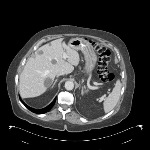 Adult ileal intussusception with secondary obstruction (Radiopaedia 30395-31051 Axial C+ portal venous phase 15).jpg