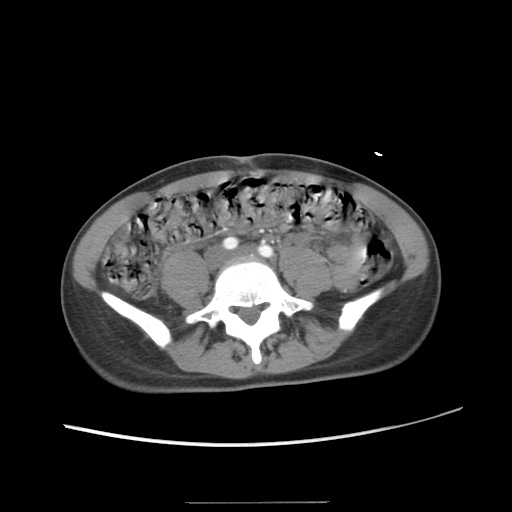 Adult polycystic kidney disease (Radiopaedia 48845-53876 Axial renal cortical phase 49).jpg