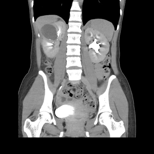 File:Adult polycystic kidney disease (Radiopaedia 48845-53876 Coronal renal excretory phase 27).jpg