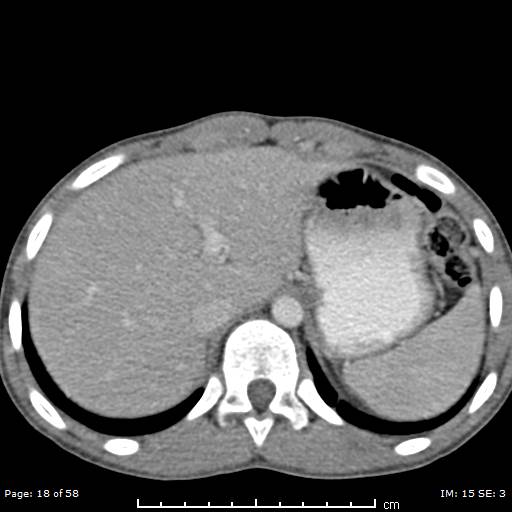 File:Agenesis of the gallbladder (Radiopaedia 55454-61905 B 18).jpg