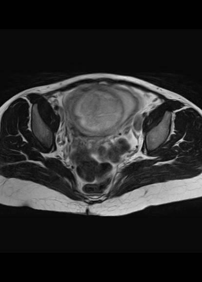 File:Aggressive angiomyxoma of the pelvis and perineum (Radiopaedia 59162-66479 Axial T2 13).jpg