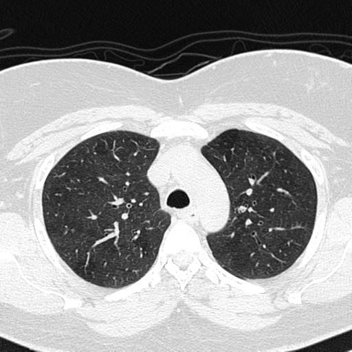 File:Air trapping in small airway disease (Radiopaedia 61685-69694 Axial lung window 46).jpg
