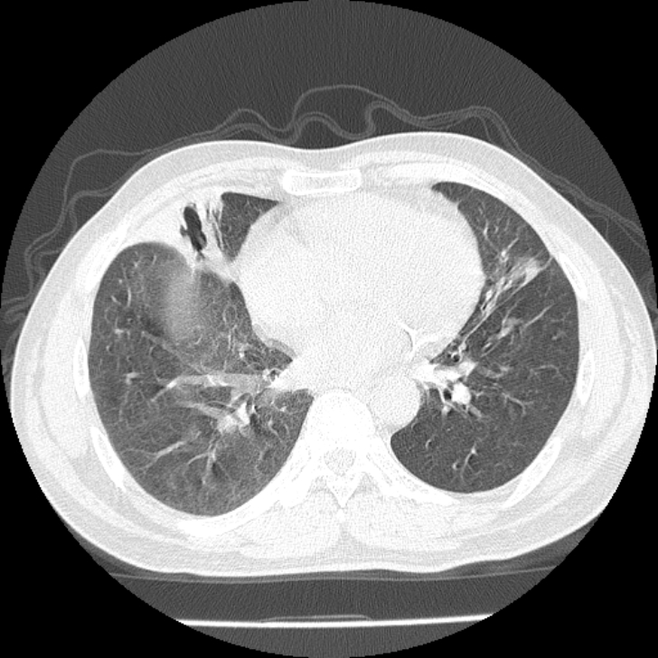 Airway foreign body in adult (Radiopaedia 85907-101779 Axial lung window 118).jpg