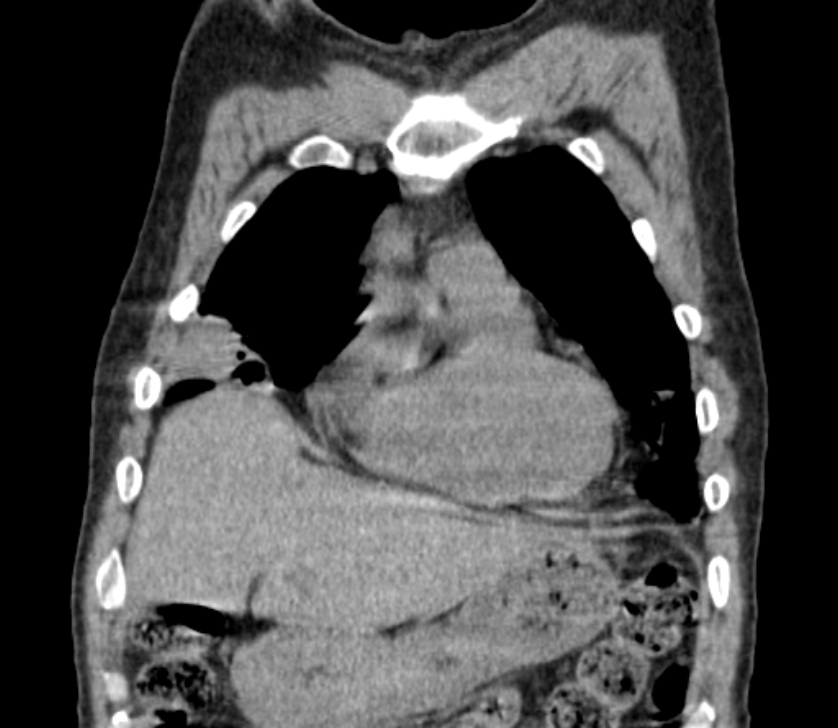 Airway foreign body in adult (Radiopaedia 85907-101779 Coronal liver window 54).jpg