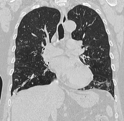 Alpha-1-antitrypsin deficiency (Radiopaedia 72058-82557 Coronal lung window 39).jpg