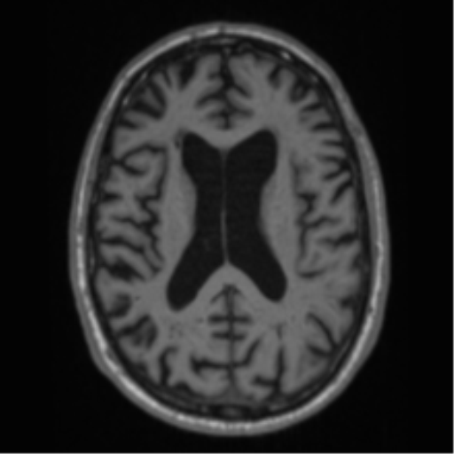 Alzheimer's disease- with Gerstmann syndrome and dressing apraxia (Radiopaedia 54882-61150 Axial T1 45).png