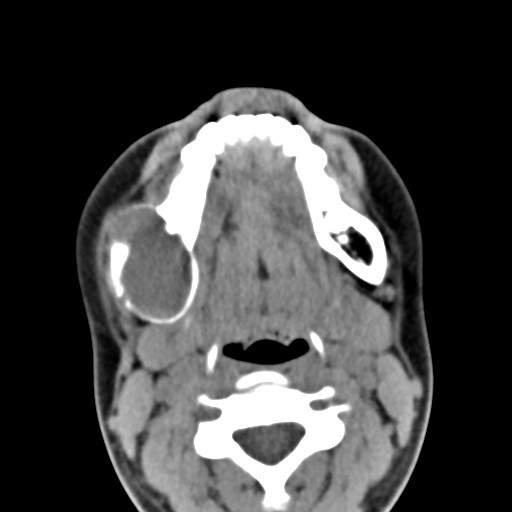 File:Ameloblastoma (Radiopaedia 26645-26793 Axial C+ delayed 14).jpg