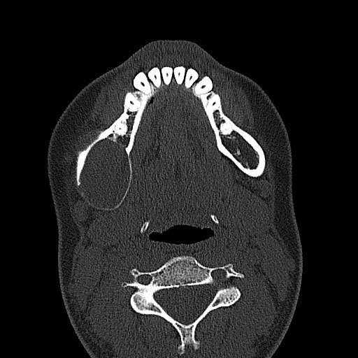 File:Ameloblastoma (Radiopaedia 26645-26793 E 25).jpg