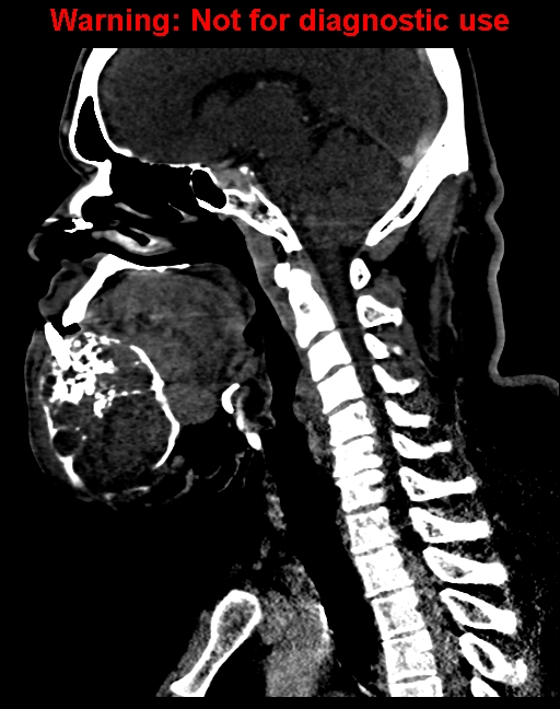 Ameloblastoma (Radiopaedia 33126-34164 F 39).jpg