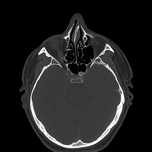 Ameloblastoma (Radiopaedia 38520-40623 Axial bone window 7).png