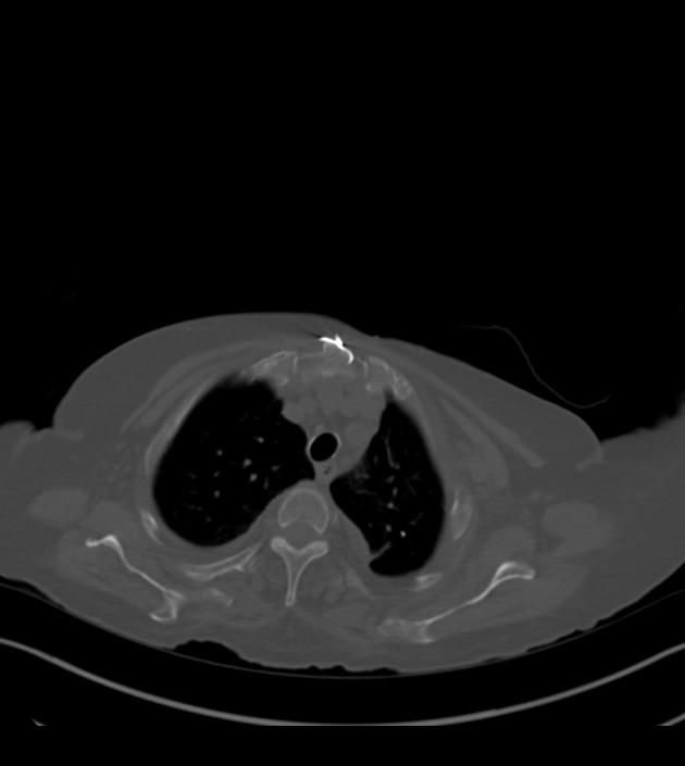 Amiodarone deposition in the liver (Radiopaedia 77587-89780 Axial bone window 17).jpg